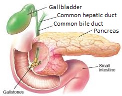 Stone in common bile duct